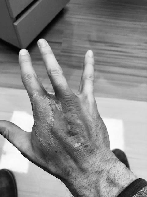Picture of a hand after radiation treatment following sarcoma surgery.