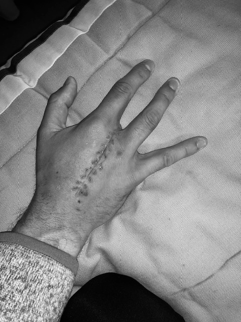 Photo of a hand post sarcoma surgery.