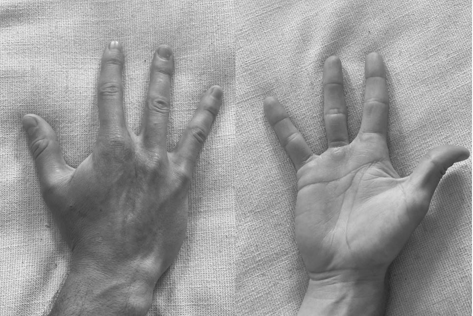 Picture of a hand after radiation treatment following sarcoma surgery.